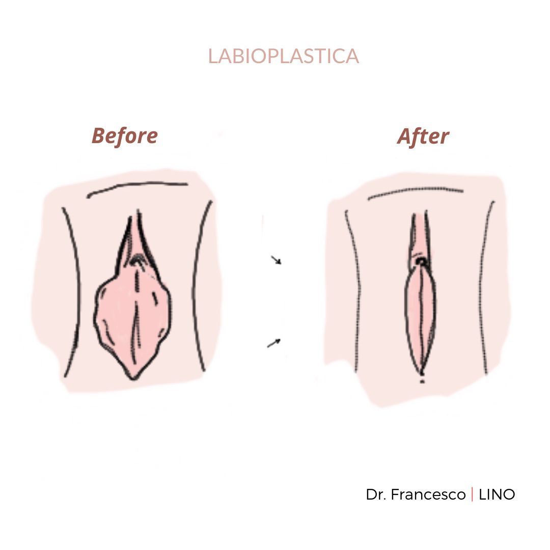 Labioplastia(1)