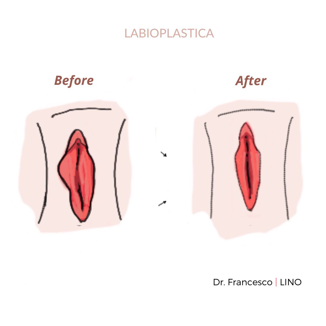 Labioplastia(2)