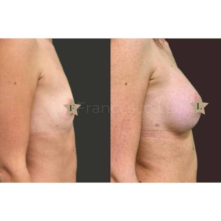 mastoplastica areolar anatomica 1