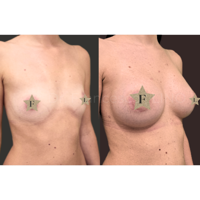 mastoplastica areolar anatomica 1