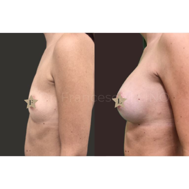 mastoplastica areolar anatomica 1