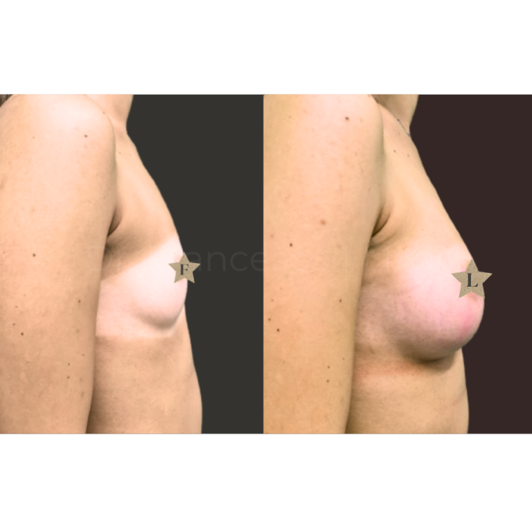 mastoplastica areolar anatomica 2