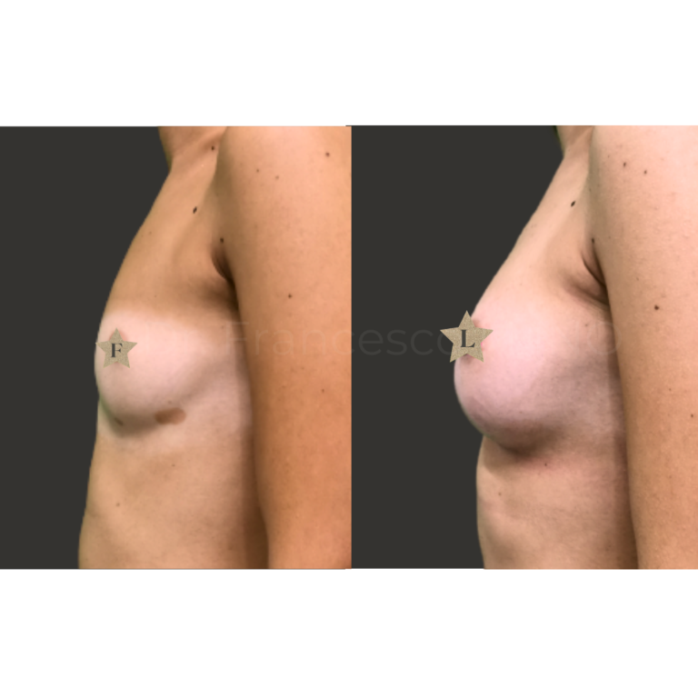 mastoplastica areolar anatomica 2
